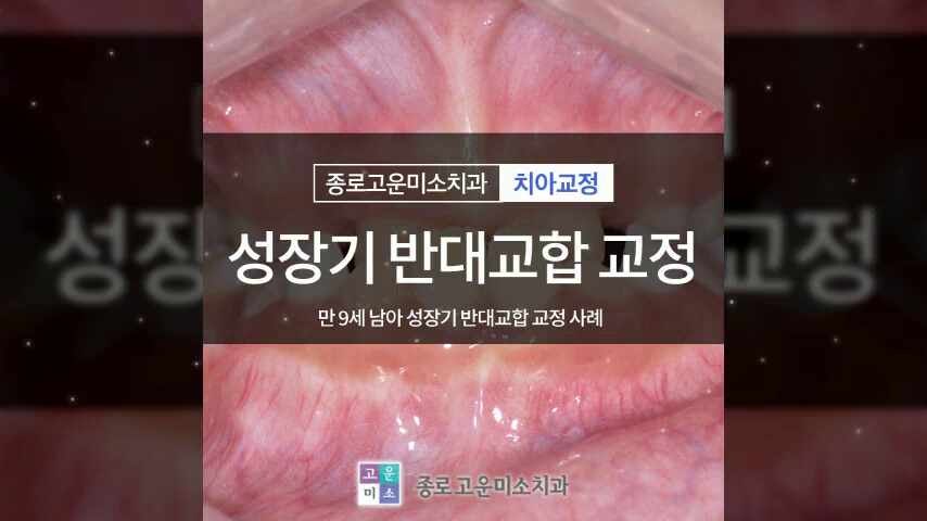 만 9세 남아 성장기 반대교합 교정 사례